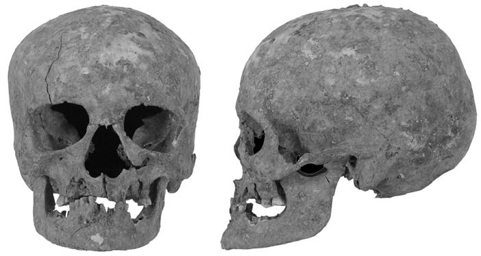4. ábra: A 797. számú objektumban nyugvó adultus-maturus korú nő koponyája (elöl- és oldalnézet). Fig. 4: Skull of the adultus-mature female from Object No. 797 (frontal and lateral view).