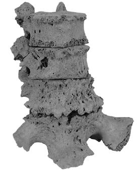 9. ábra: A sacrum felső részének és az ágyéki csigolyák testének oldalán jelentős