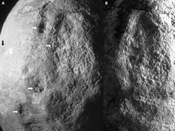 3. ábra: Algyő-258. sz. kútkörzet, 10. századi lelőhely 28. számú sírjából származó maturus férfi koponyája. A: a koponyatetőn található 5 jelképes trepanáció elhelyezkedése.
