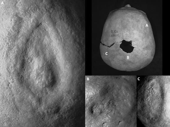 B: the almond-shaped scraped lesion on the right parietal. 4. ábra: Bélmegyer-Csömöki-domb lelőhely 27.