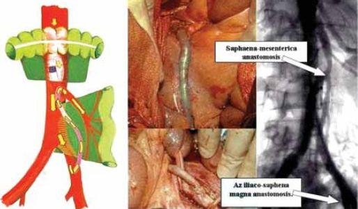 15 14. ábra. Az iliaco-mesenterica bypass rajza, műtéti és angiographiás képe.