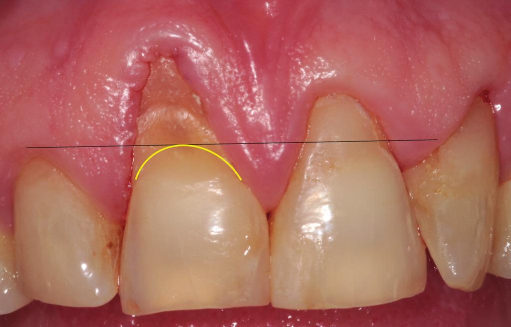 Ezt az elhajlást a dentin rugalmassága károsodás nélkül követi, azonban a teljesen rigid zománcprizmákban mikro repedések keletkeznek, amik végül a zománc kipattogzásához vezetnek [39, 33].