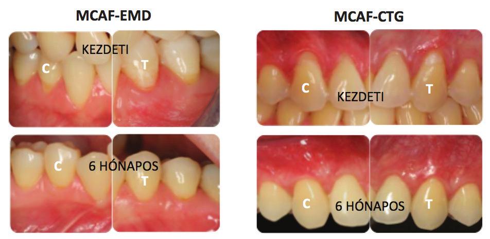 FOGORVOSI SZEMLE 110. évf. 4. sz. 2017. 129 8. kép: Pre- és posztoperatív parodontális állapot a teszt és a kontroll oldalon a MCAF+EMD, valamint MCAF+CTG műtétek után.