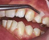 felszínekre és olyan fogakra, melyeket kivehető pótlások kapcsai kikoptattak zománcsérüléseket szenvedett fogaknál (pl.