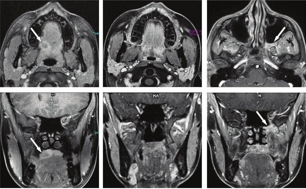 MRI ÉS CT FEJ-NYAKI DAGANATOK SUGÁRTERÁPIÁJÁNÁL 169 Kigészítő árák KIEGÉSZÍTŐ 1. ÁBRA., ) Anoi isztikus krinóm (nyíl) jo ollon kmény- és lágyszájp átmntén., ) RT utáni, tumormnts státusz.