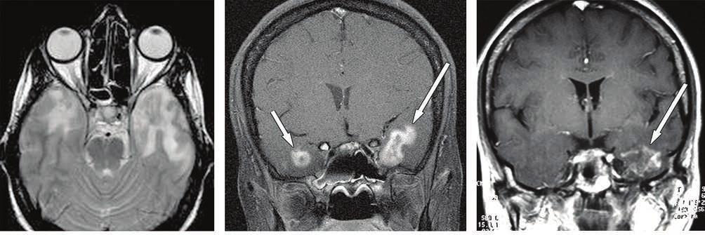 MRI ÉS CT FEJ-NYAKI DAGANATOK SUGÁRTERÁPIÁJÁNÁL 173 KIEGÉSZÍTŐ 8. ÁBRA. Posztirriáiós rritisz minkét olli tmporális lnyn pirinxrák irriáiój után három évvl. MRI-rétgk.