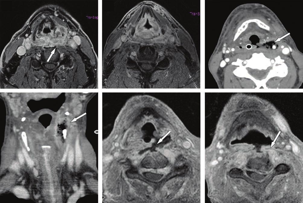 MRI ÉS CT FEJ-NYAKI DAGANATOK SUGÁRTERÁPIÁJÁNÁL 165 5. ÁBRA. Hátsó li hiporinxrák és KRT utáni, tö szövtt érintő szövőmény. ) MRI, xiális CT1FS: primr tumorstátusz.