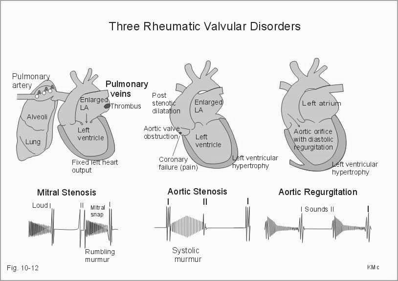 The hallmark of aortic regurgitation/insufficiency is a high-pitched decrescendo diastolic murmur at the left sternal border after the second heart sound.