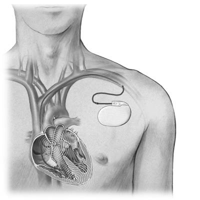 Pacemaker terápia Antitachycardia pacemakerek: ICD: implantálható cardioverter defibrillator -Kamrai tachycardia ill. fibrillatio esetén defibrillál.