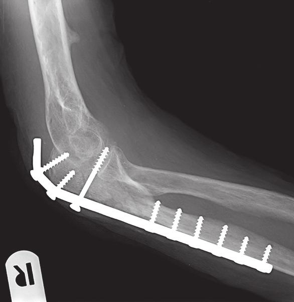 a) b) c) 7. ábra. a) Műtét utáni atípusos AP könyök-röntgenfelvétel. A második beteg jobbkönyök-röntgenfelvételei a törés rögzítése és a beteg állapota miatt atípusosak.