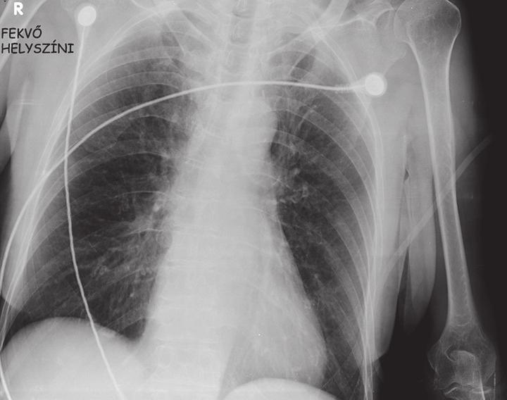 A második beteg jobb oldali, atípusos oldalirányú könyök-röntgenfelvétele az operációt követő kontroll során, rajta szintén látható a csontnyúlvány. c) Helyszíni, fekvő mellkas-röntgenfelvétel.