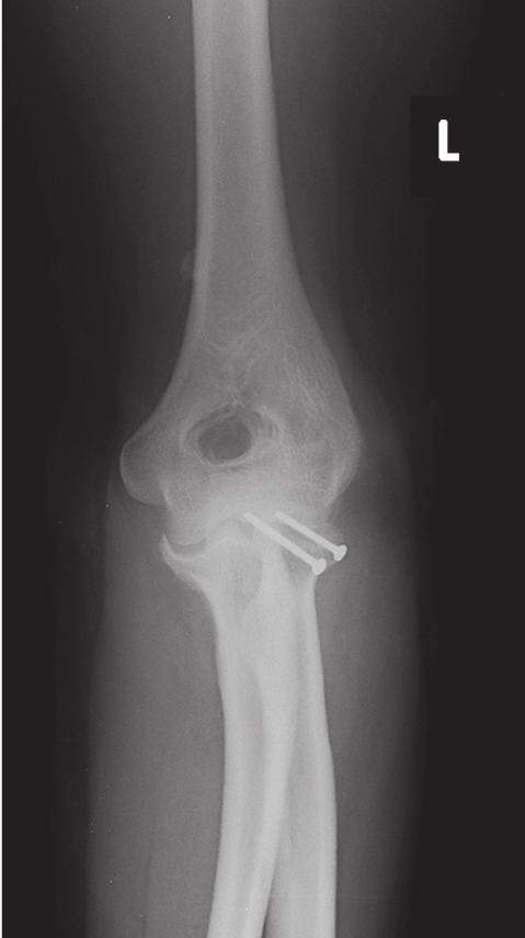 A harmadik beteg oldalirányú könyök-röntgenfelvételén a humeruson látható csontnyúlvány jelentősebben kivetül, mint az AP felvételen Harmadik beteg Az 54 éves nő elesett, bal radiusa sérült.