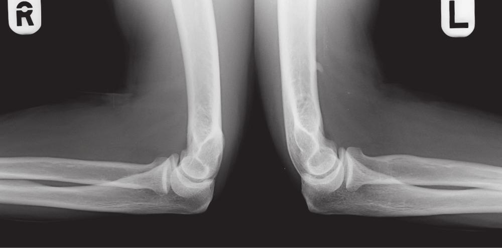 A negyedik beteg összehasonlító oldalirányú könyök-röntgenfelvétele, ahol a bal (L) oldali humeruson látható egy tüskés képlet Negyedik beteg Egy 49 éves nő mindkét, de főként jobb oldali könyök-,
