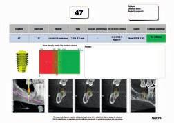 ACTEON Imaging Suite szoftver STL formátumú fileba exportálja az X-mind Trium által