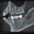 vagy több implantátum pozícionáláshoz vagy parodontális elváltozások