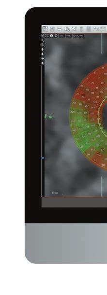 Kommunikáció a pácienssel Ha kevés a csont térfogata, az ACTEON Imaging Suite 3D szoftver által megjelenített