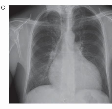 frekvenciájú pitvari tachycardia váltakozása látható.