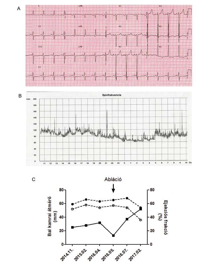 beteg három ambuláns kardiológiai kontrollvizsgálaton vett részt, a carvedilol dózisát 2 12,5 mg-ra növelték, további terápiamódosítás nem történt.