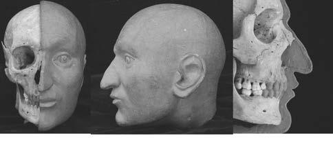 240 Milan Thurzo Radoslav Beňuš Imrich Thurzo (1598 1621) 1 Pri analýze kostrových pozostatkov Imricha Thurzu sme mali problémy s hodnotením jeho lebky, keďže na jej celej ľavej strane vykonal doktor