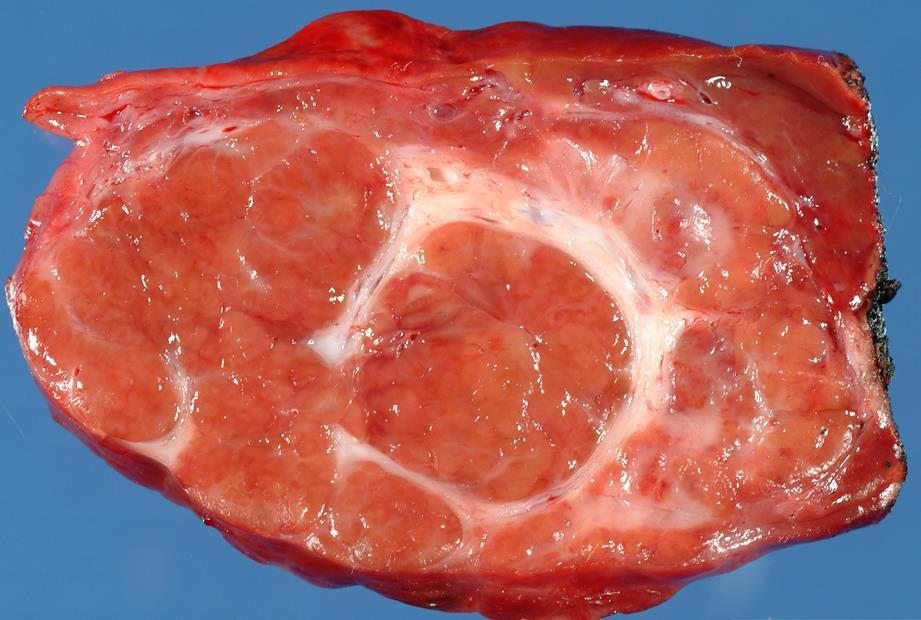 B/63 Májdaganatok és daganatszerű léziók Tumor-szerű léziók: Focalis nodularis hyperplasia -több cm is lehet -gyakran ép májban alakul ki.