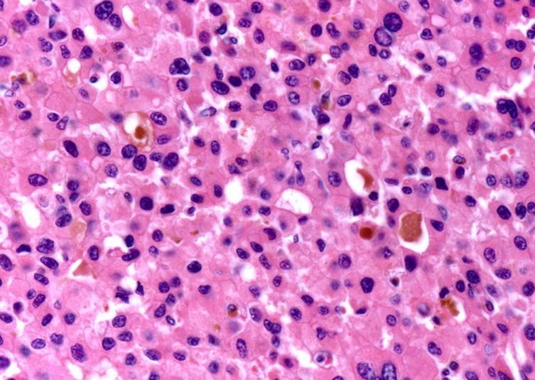 Malignus tumorok Hepatocellularis carcinoma Pathogenesis: