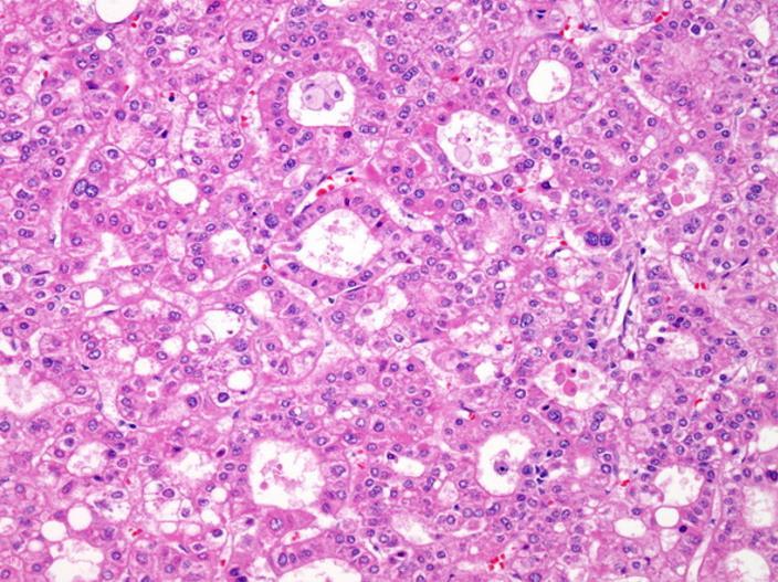 Paraneoplasticus jelek polycythemia, hypoglycemia,