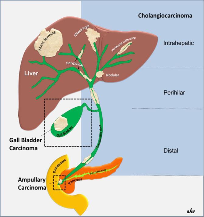 Malignus tumorok Cholangiocarcinoma Intrahepaticus