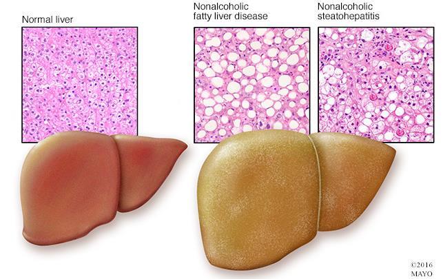 B/61 NAFLD nem alkoholos zsírmáj betegség Rizikótényezők: Magas koleszterin Magas triglicerid