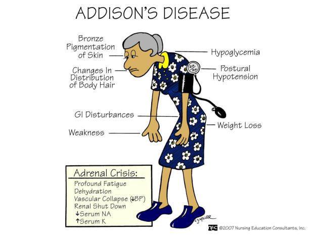 Kevés termelődik: Addison kór (pigment felszaporodással jár) autoimmun betegség Korai tünetek: fáradékonyság, izomgyengeség, kedvetlenség,