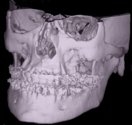 A tárgy 3D rekonstrukciója CT 3D rekonstrukció sok egy dimenziós adatfelvétel síkok denzitásmátrixa 3D