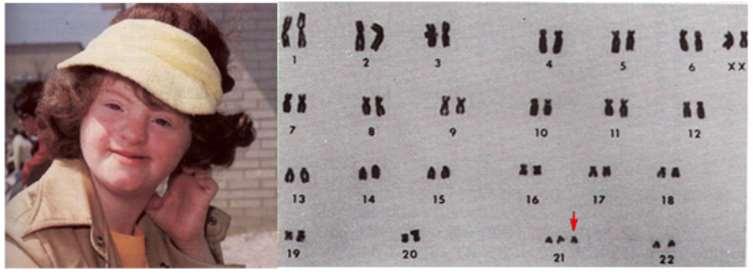 Inverzió: egy kromoszóma szakasz 180 fokos átfordulása az adott kromoszómán belül. Transzlokáció: két nem homológ kromoszóma közötti részek (kölcsönös) áthelyeződése.