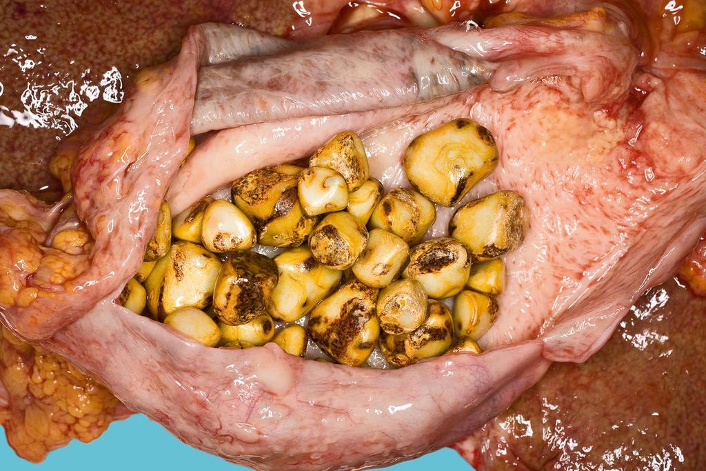 Idült cholecystitis: a lumenben