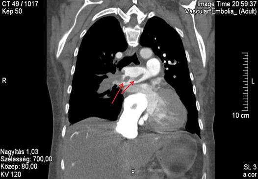 mellkasi CT vizsgálatot, melyen kétoldali kisebb, lebenyágakat érintő tüdőembolia igazolódott. 5.