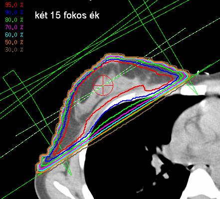 Standard besugárzási technika emlőmegtartó műtét után -