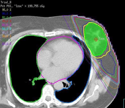 Akcelerált parciális emlő radioterápia (APERT) Kisebb besugárzott térfogat (részleges versus teljes emlő besugárzás) Céltérfogat = tumorágy + 1-2 cm biztonsági