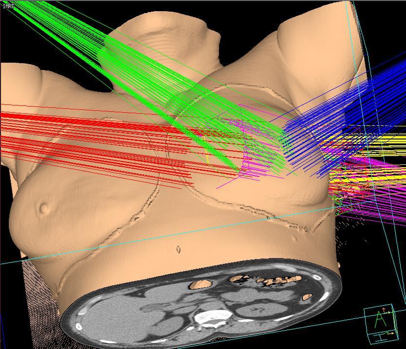 APERT külső sugárkezeléssel 3D-KRT