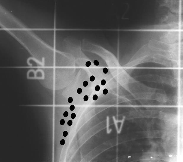 Axilla-supraclavium besugárzása Mezőhatárok: lateralis: humerus fej közepe medialis: kp.