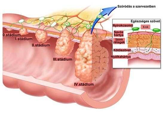 PREKLINIKAI SZAKASZ MODELLJE VASTAGBÉLRÁK ESETÉBEN Korév 35 A 55 A rákos elváltozás kezdete Átmérője 1 cm