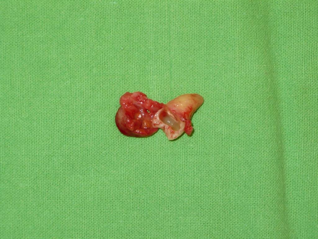 CYSTECTOMY OF