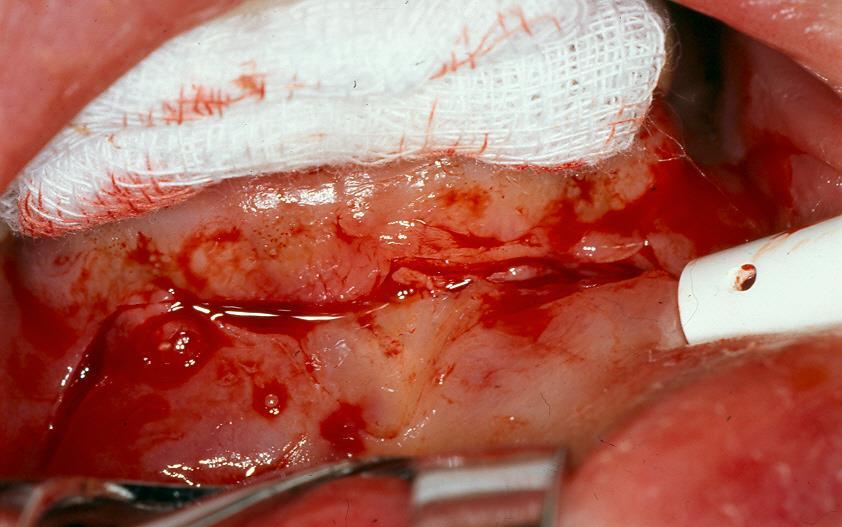 CYSTECTOMY OF