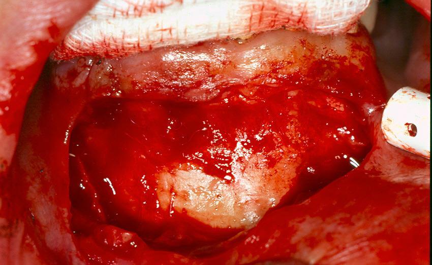 CYSTECTOMY OF