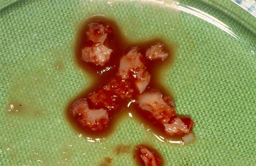 CYSTECTOMY OF