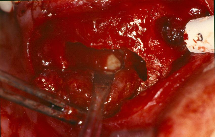 CYSTECTOMY OF