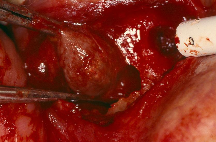 CYSTECTOMY OF