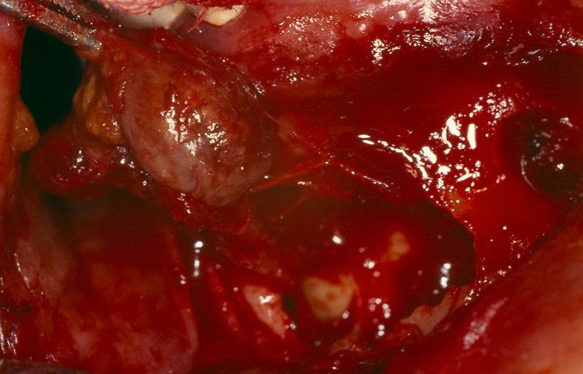CYSTECTOMY OF