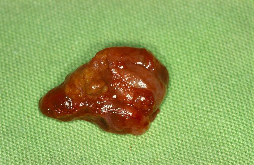 CYSTECTOMY OF