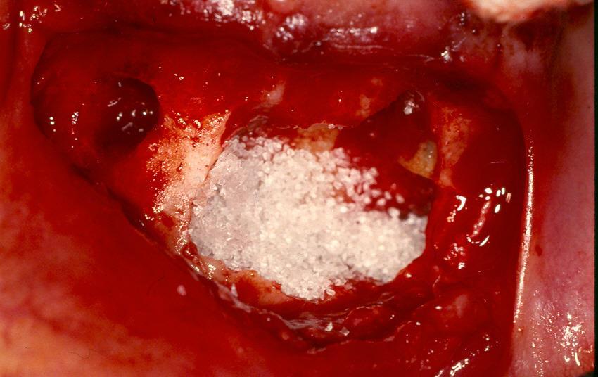 CYSTECTOMY OF RADICULAR CYST Bone-graft