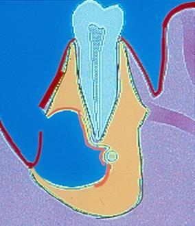 ) with partial enucleation (marsupialization) c.