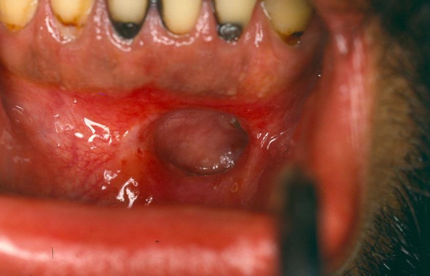 WITH PARTIAL ENUCLEATION (MARSUPIALIZATION) Kép