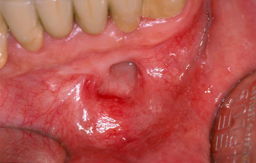 WITH PARTIAL ENUCLEATION (MARSUPIALIZATION) Kép